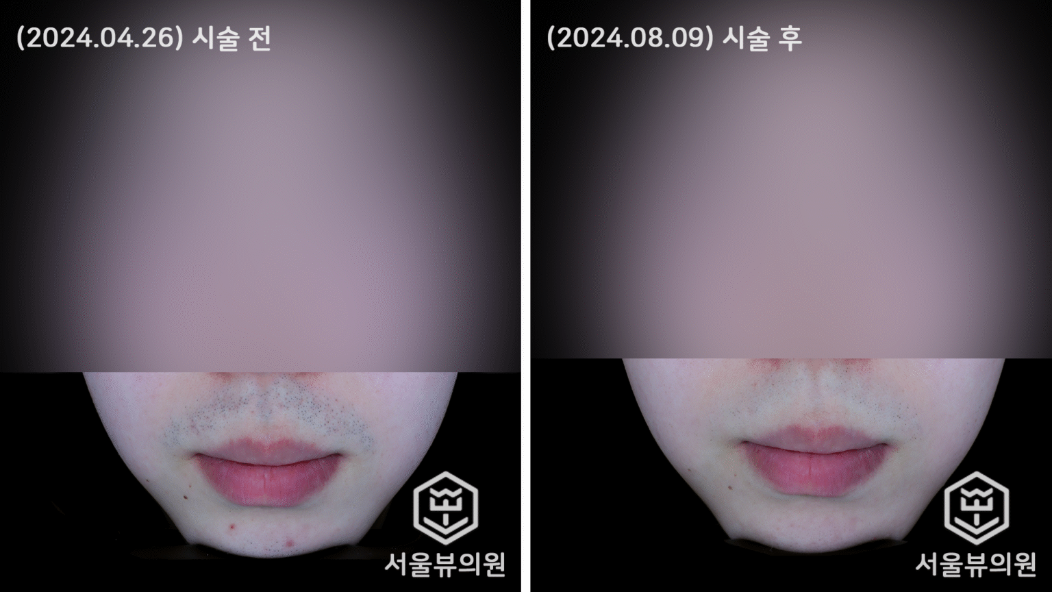 Before&After - [레이저 제모] - 서울뷰의원 청주