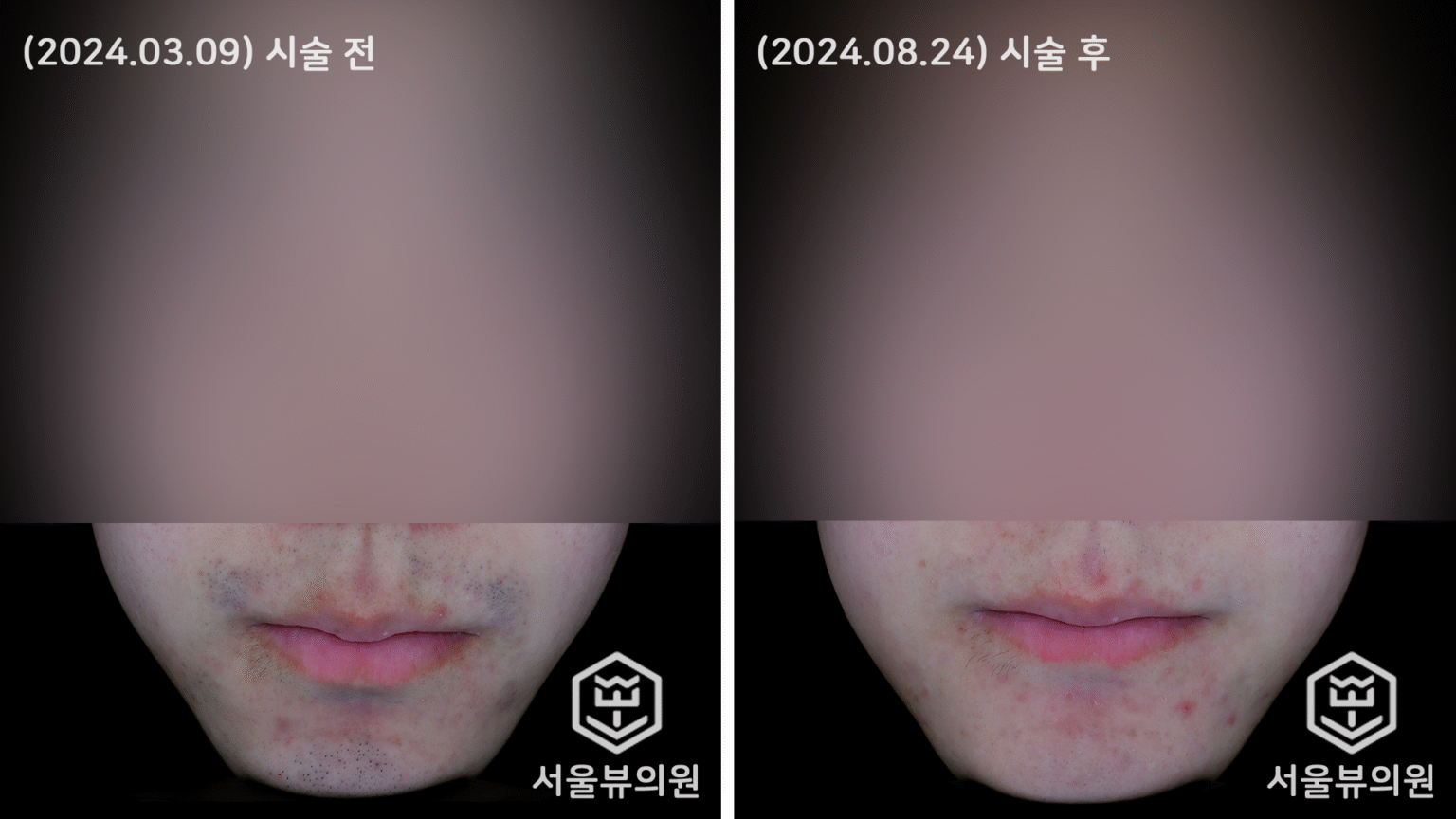 Before&After - [레이저 제모] - 서울뷰의원 청주