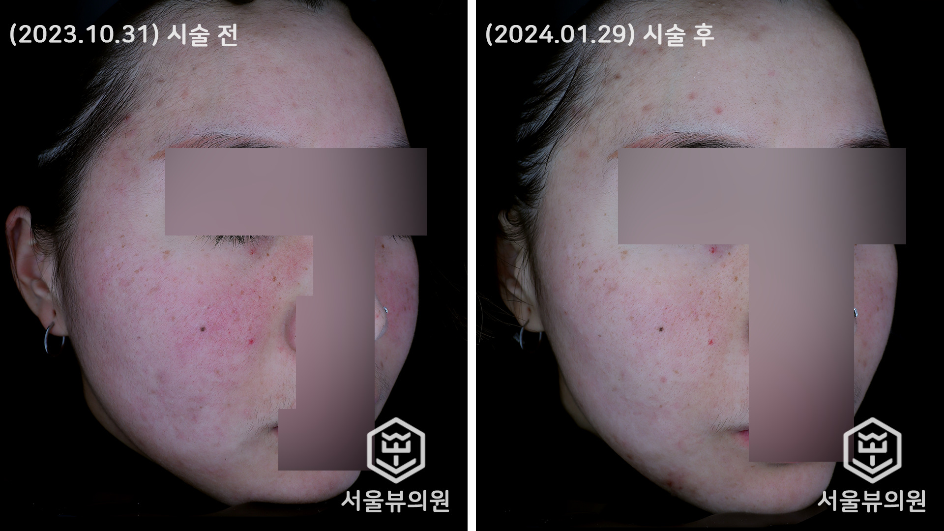 skin20