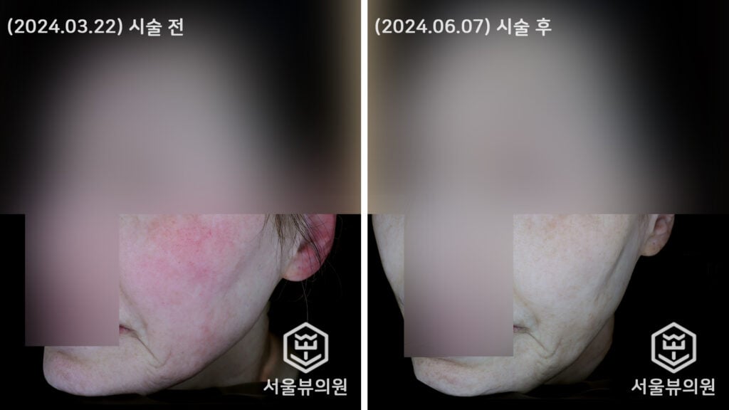 skin6