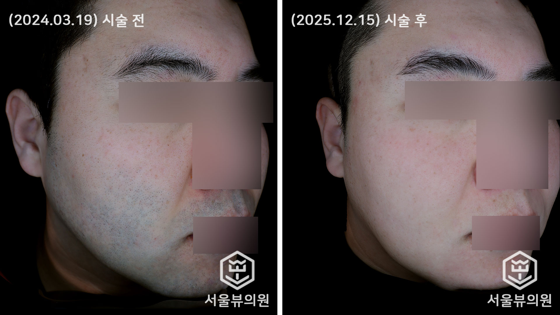 Before&After - [레이저 제모] - 서울뷰의원 청주
